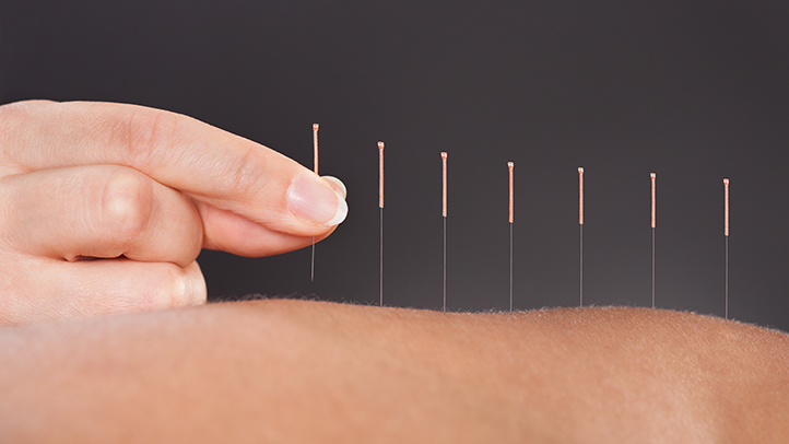 Acupuncture for chronic pain Alpert Acupuncture Chinese Medicine Clinic - מרפאת דיקור סיני